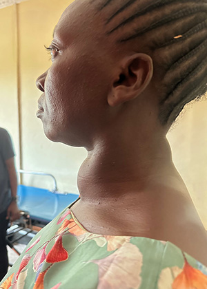 Thyroid surgery candidate