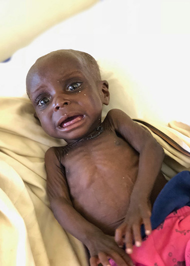 Malnourished baby Witness 2018